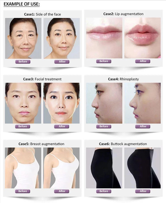 리볼아스 좋은 깊은 서브-Q 히알루론산 교차하는 연결된 피부 필러 1.1 밀리람베르트