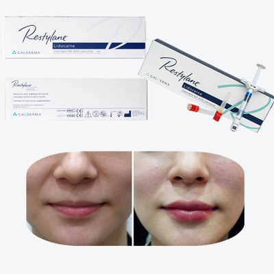 Juvederm Cross Linked 주입 가능한 입술 피부 필러