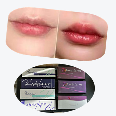 2*1ml/ Box Cross Linked Dermal Filler for Lips Augmentation (입술 증강을 위한 횡단 연결 피부 필러)