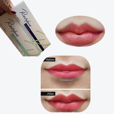 2*1ml/ Box Cross Linked Dermal Filler for Lips Augmentation (입술 증강을 위한 횡단 연결 피부 필러)