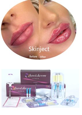 Juvederm 히알루론산 얼굴 피부 필러 주입 용품 2*1ml 포장