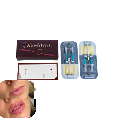 Juvederm 입술 주사용 피부 필러 히알루론산 필러