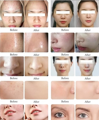 신제품 블랙 진주 10인1 하이드라 껍질 벗기기 기계 마이크로 피부 깎기 기계 얼굴 스파 마이크로 터치 하이드라 피부 관리