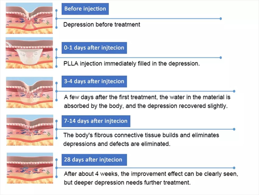 PLLA 폴리- L- 젖산 얼굴 주입 10 병 150mg