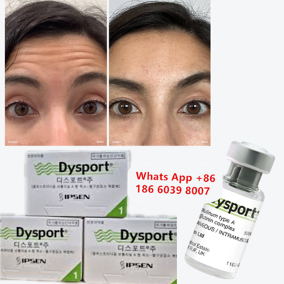 Dysport Botulinum Toxin Type A for Frown and Glabellar Lines (얼굴과 눈의 선에 대한 디스포트 보툴리넘 독성물질 A)