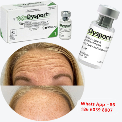 Dysport Botulinum Toxin Type A Anti-Wrinkle Injection for Apple-shaped cheekbones