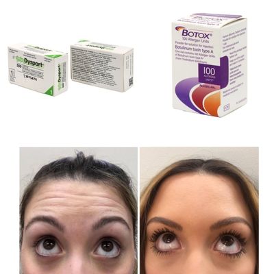 주름 및 잔주름 개선용 한국산 BTX 보툴리눔 톡신 100 유닛