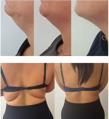 레몬병 지방 분해 주사 립틱 용액