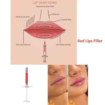 즉각적인 회복 시간 Revolax Deep Filler 입술 증강에 탁월한 자연스러운 결과와 최소한의 다운타임을 제공합니다