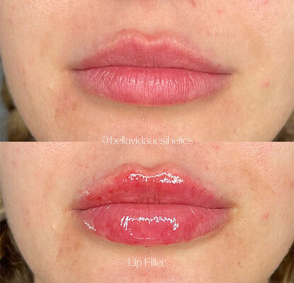 유효기간 2년 피부 필러 주사용 젤 주사용 젤은 주름을 줄이기 위해 고안되었습니다.