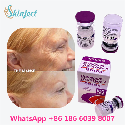 Botulinum Toxin BOTOX 화장품 100 단위 알레르기성 Onabotulinum ToxinA 얼굴 주름
