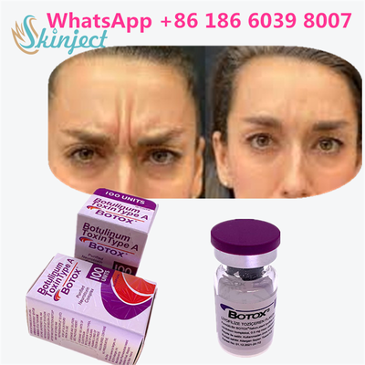Botulinum Toxin BOTOX 화장품 100 단위 알레르기성 Onabotulinum ToxinA 얼굴 주름