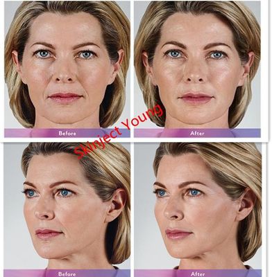 Juvederm Voluma 2x1ml 히알루론산 주사용 젤 필러