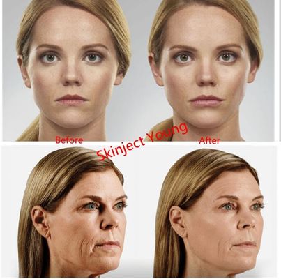 Juvederm Voluma 2x1ml 히알루론산 주사용 젤 필러