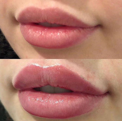 러시안 립스 Juvederm Ultra 3 with  Cross Linked Dermal Filler