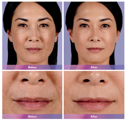 입술 확대를 위한 Juvederm 피부 필러 립 인젝션 울트라 4