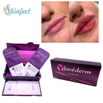 비순 주름 LIP 2x1ml 피부 필러 히알루론산 주이더텀 Ultra3