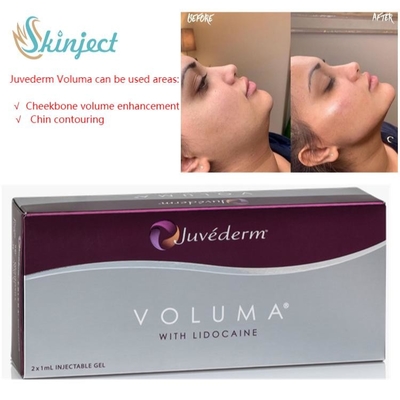 광대뼈를 위한 주이더텀 볼우마 2x1ml 히알루론산 피부 필러