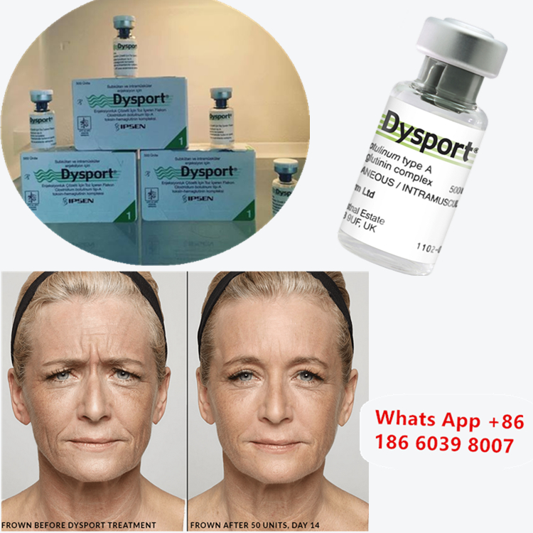 Dysport 500u Botulinum Toxin A형 턱대이를 증강하기 위해
