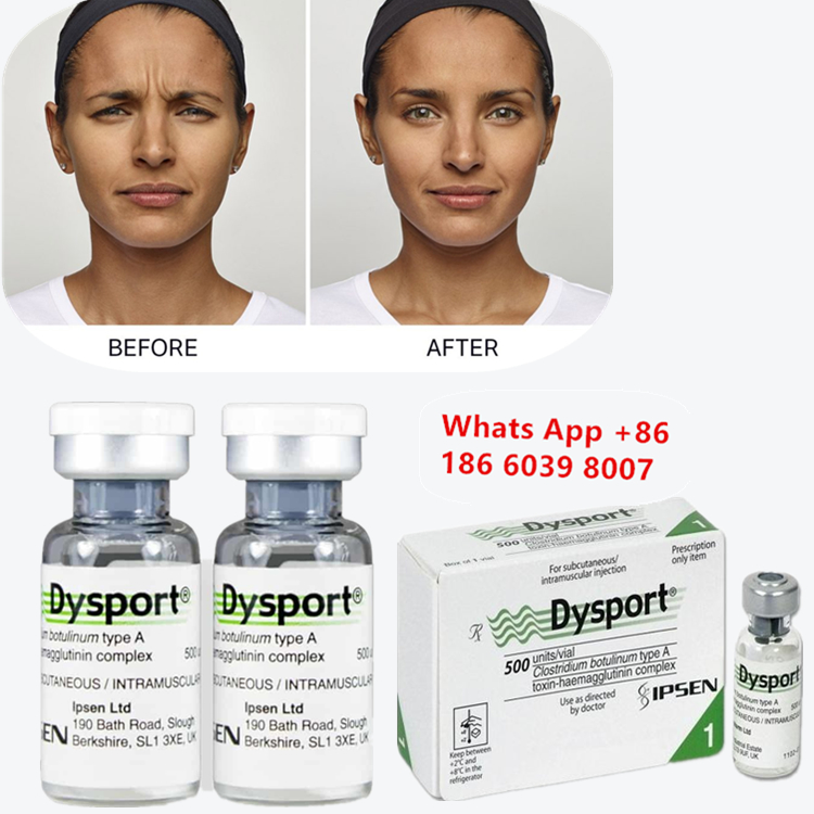 Dysport Botulinum Toxin Type A for Frown and Glabellar Lines (얼굴과 눈의 선에 대한 디스포트 보툴리넘 독성물질 A)